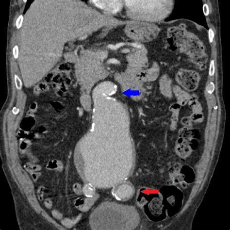 Contrast Enhanced Axial Ct Of The Abdomen And Pelvis Level Of L4