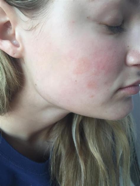 Random Red Patches On Face Rosacea And Facial Redness