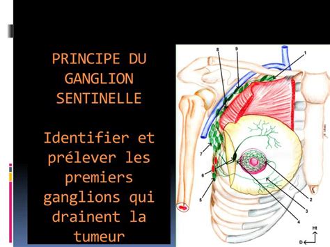 Ganglion Sentinelle Schema Cancer Du Penis Quels Symptomes Et Hot Sex Picture