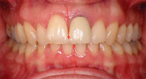 How To Fix Off Center Teeth Sosa Kinge1950