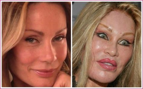 Cat Woman Jocelyn Wildenstein Plastic Surgery Before And After