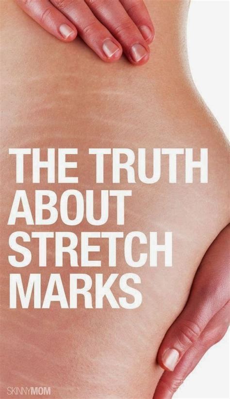 May 04, 2021 · a police officer murdered the former aston villa striker dalian atkinson, first shooting him with a taser stun gun for 33 seconds, then kicking him in the head as though striking a football. Stretch Marks removal in 2020 | Stretch marks, Stretch ...