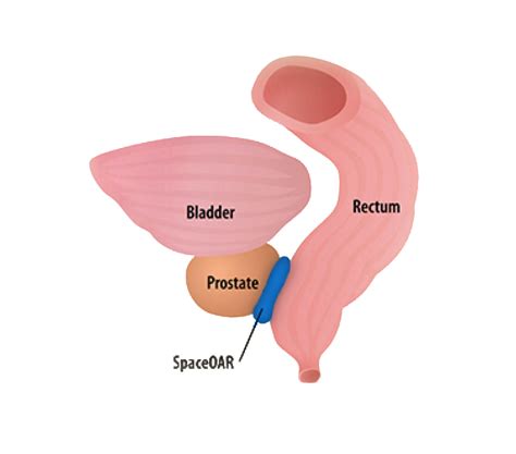 Spaceoar Vue Hydrogel Hcp Resources Practice Resources Boston Scientific