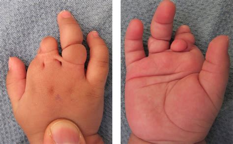 Congenital Hand Differences A Review Iranian Journal Of Pediatrics