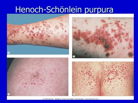 Ppt Cutaneous Vascular Diseases Powerpoint Presentation Free