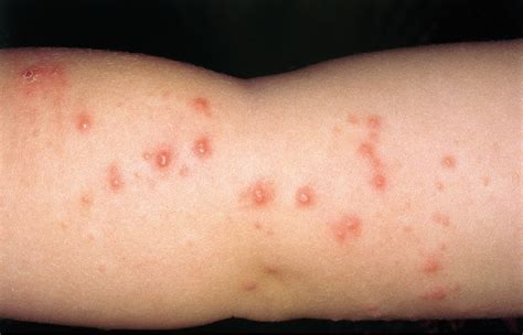Aprender Sobre 38 Imagem Dermatite Herpetiforme Fotos Br