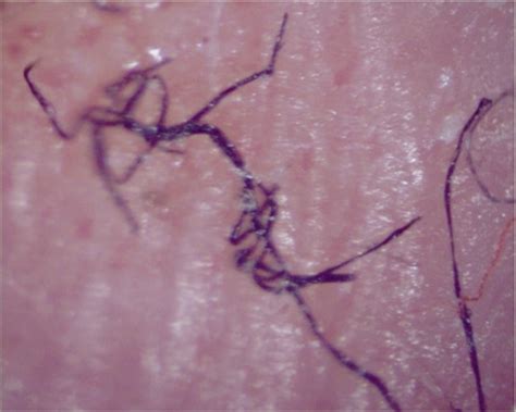 Morgellons Images Pictures Photos