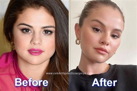 selena gomez plastic surgery before and after with pics