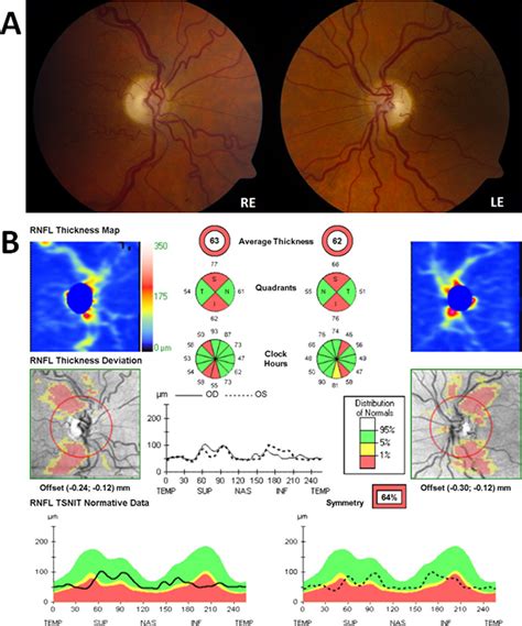 Optic Discs Appearance And Optical Coherence Tomography Oct Findings Download Scientific