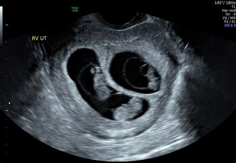 Triplets Ultrasound 30 Weeks
