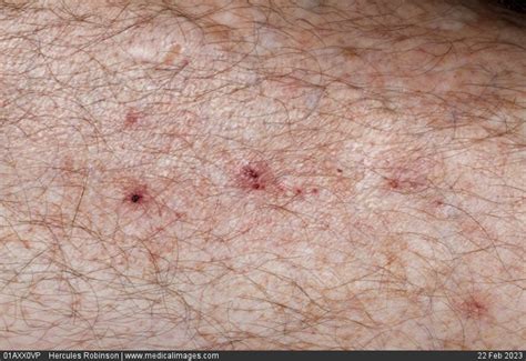 Stock Image Dermatology Excoriated Dermal Rash Pink Patches And Small