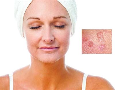 Understanding Sebaceous Hyperplasia Causes Symptoms And Treatment
