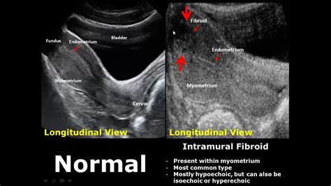 Uterus Ultrasound Normal Vs Abnormal Image Appearances Comparison Uterine Pathologies Usg