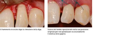 Gestione Dell'urgenza In Un Trauma Dentale Che Ha ...