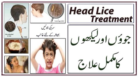 Head Lice Treatment 3 Easy And Fast Ways Ll سر کی جوؤں اور لیکھوں کا مکمل خاتمہ Youtube