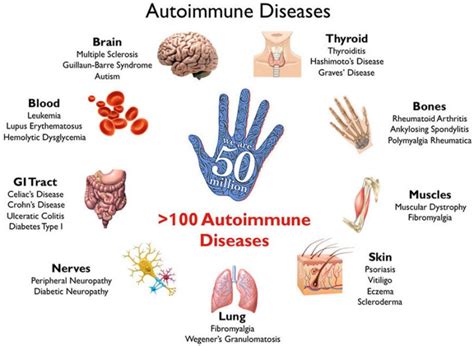 Auto Immune Diseases Dr Sonal Sanghavi