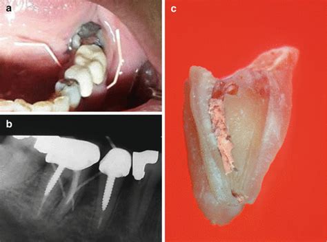Case Presentations Of Vertical Root Fractures Pocket Dentistry
