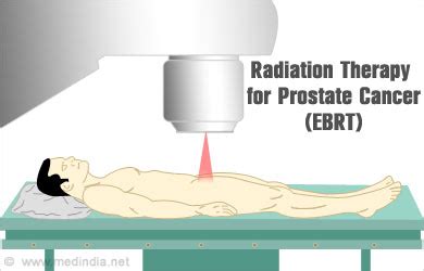 External Beam Radiation Therapy For Prostate Cancer