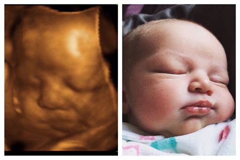 Baby Before And After Baby Ultrasound Prenatal Baby 4d Ultrasound