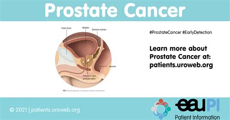 Know Everything About Prostate Cancer Patient Information