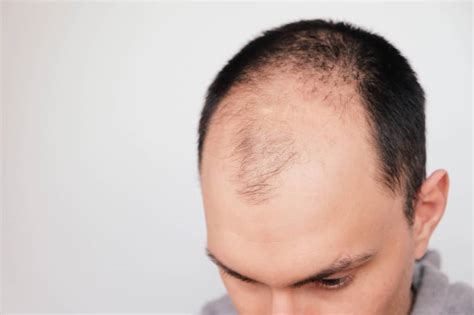 Causes Of Hair Loss In Men Ultimate Guide