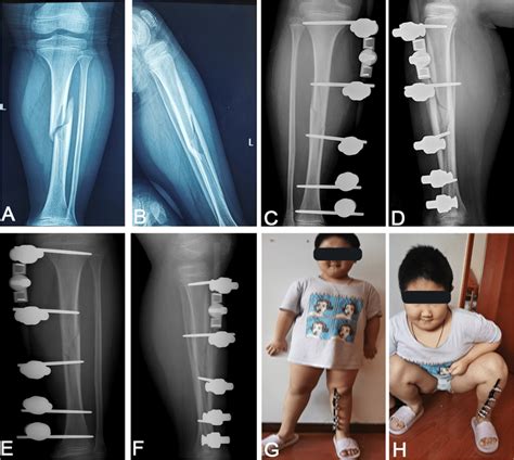 Representative Cases With Tibia Shaft Fractures At Preoperation And