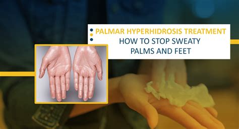 Palmar Hydrosis Treatment How To Stop Sweaty Palms And Feet