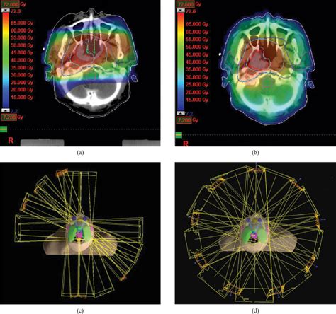 Figure 1 From Superiority Of Intensity Modulated Radiotherapy Over