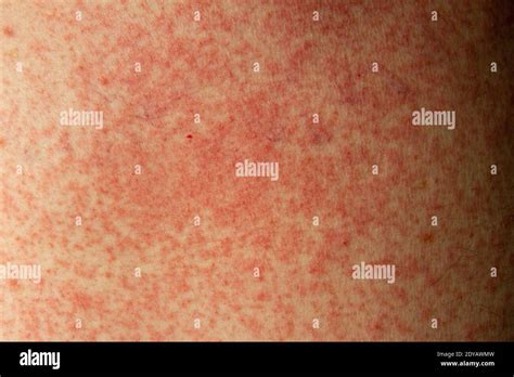 Allergic Reaction Skin Rash Hi Res Stock Photography And Images Alamy