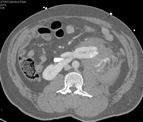 Left Renal Laceration With Hematoma And Contrast Extravasation Trauma