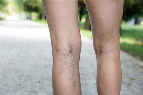 Is Venous Insufficiency The Cause Of Your Restless Legs Syndrome