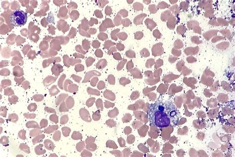 Peripheral Blood Smear Shows A Circulating Hemphagocytic Histiocyte