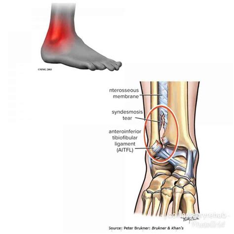 High Ankle Sprain Vs Ankle Sprain Whats The Difference Injury