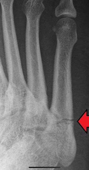 Treatment may involve surgery, and recovery can take up to four months. Jones Fractures | Resurgens Orthopaedics
