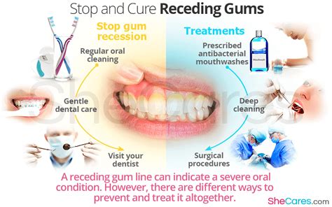 Stop And Cure Reciding Gums Gum Treatment Receding Gums Gum
