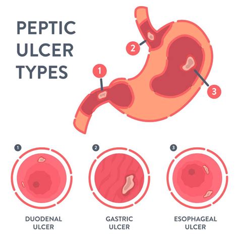Peptic Ulcers Symptoms And Causes Gleneagles Hospital