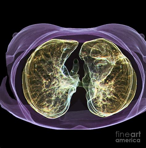 Healthy Lungs 3d Ct Scan Photograph By Zephyr Pixels