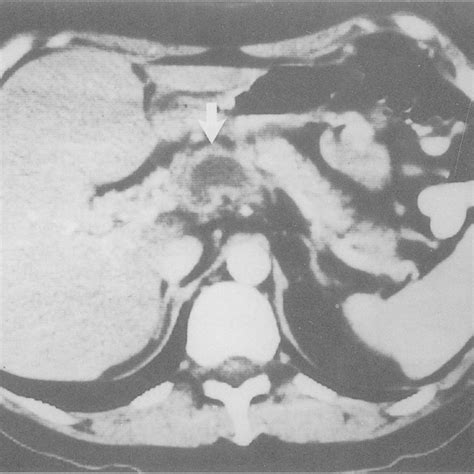 Abdominal Computed Tomography Ct Scan With Oral And Intravenous