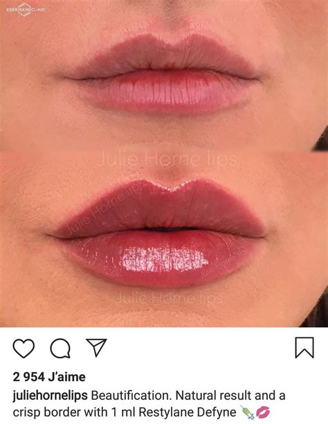 Lip Fillers Before And After Cupids Bow Before And After