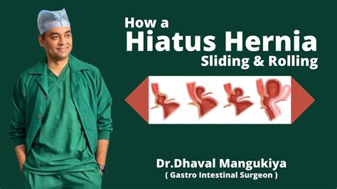 How A Hiatus Hernia Sliding And Rolling Is Formed Symptoms And
