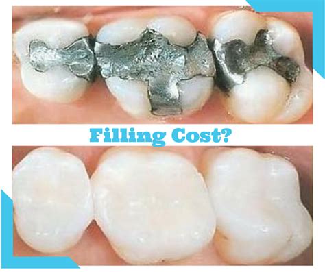 Maybe you would like to learn more about one of these? Are you searching for How Much Does a Filling Cost? here you will have an idea about dental ...
