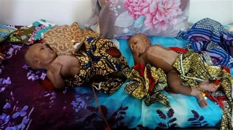 Incredible Team Of Nigerian Doctors Separate Conjoined Twins In Yola