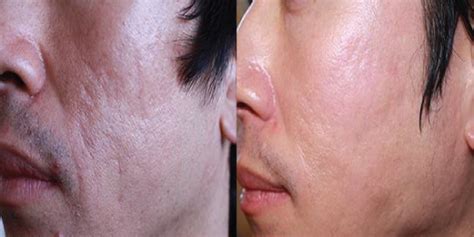 Microneedling A Great Treatment For Acne Scars Redondo Beach