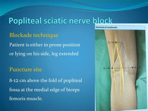 Ppt Peripheral Nerve Blocks Using Nerve Stimulator Powerpoint
