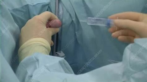 Turp Biopsy Procedure Stock Video Clip K0038579 Science Photo