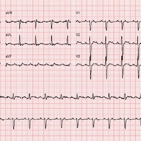 12 Lead Electrocardiogram Showing Atypical Atrial Flutter At 101 Bpm