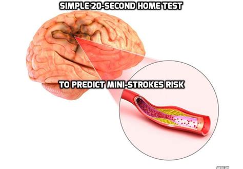how to better predict mini strokes risk like a doctor