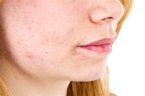 Skin Rash On One Side Of Face Allergy Trigger