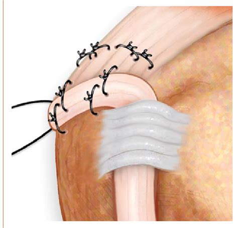 Figure 1 From Arthroscopic Rotator Cuff Repair With Biceps Tendon
