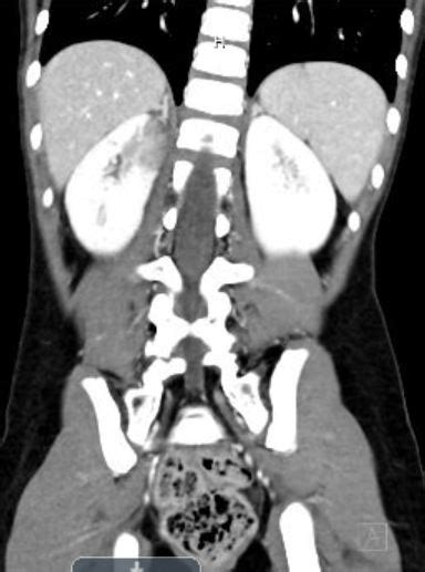 Ct Scan With Contrast View Coronal View Acute Pyelonephritis American